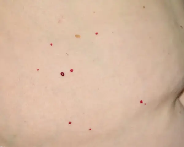 Czerwone pieprzyki na brzuchu, drobne i kilka większych, rozrzucone na jasnej skórze.
