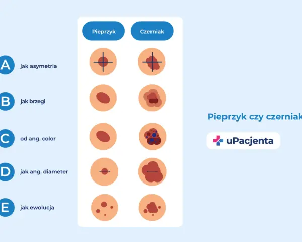 Porównanie pieprzyka i czerniaka: asymetria, brzegi, kolor, średnica i ewolucja. Jak wygląda czerniak skóry?