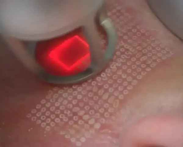 Zabieg laserem frakcyjnym: czerwony promień lasera tworzy na skórze siatkę mikrouszkodzeń. Czy laser frakcyjny boli? Odczucia są indywidualne.