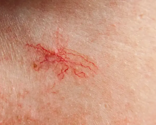 Widoczne popękane naczynka na piersiach, tworzące delikatną, czerwoną pajęczynkę na jasnej skórze.