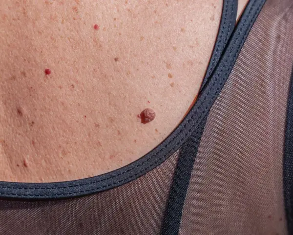 Skóra z piegami, brodawkami i kilkoma punkcikami rubinowymi. Czy te punkty rubinowe a tarczyca mają związek?