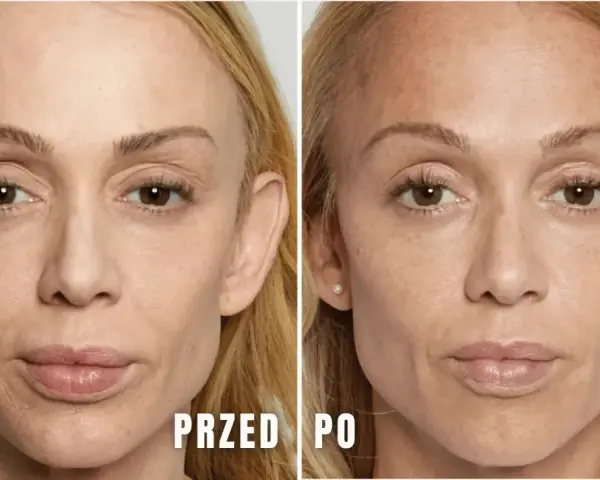 Przed i po zabiegu: wygładzenie skóry pod oczami dzięki kwasowi polimlekowemu. Skóra wygląda na bardziej napiętą i odmłodzoną.