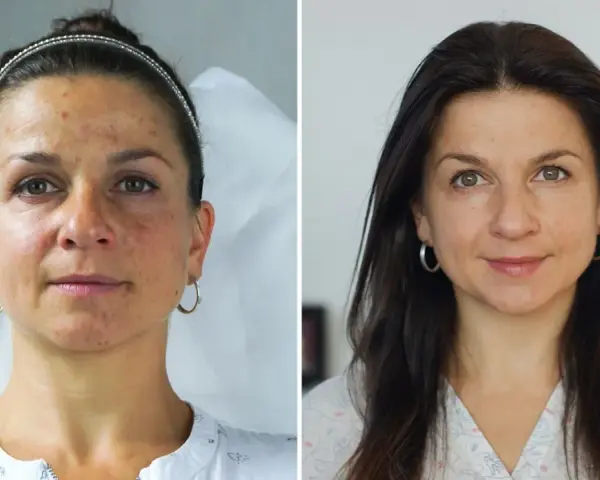 Przed i po zabiegu: skóra z niedoskonałościami i przebarwieniami staje się gładka i promienna. Fibryna pod oczy zdziałała cuda!
