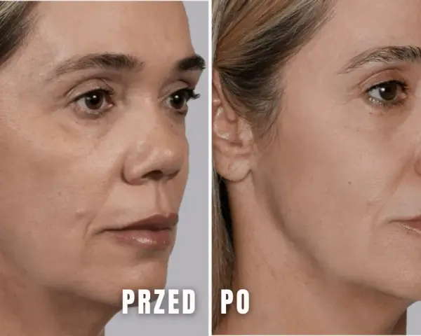 Przed i po zabiegu juvelook pod oczy. Skóra wokół oczu wygładzona, zmarszczki zredukowane.