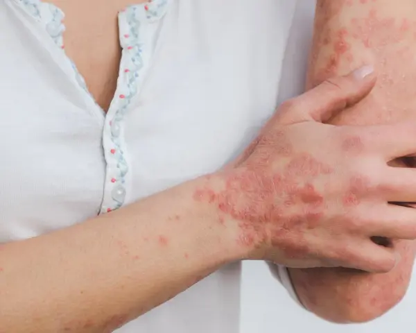 Ręka i przedramię z widocznymi, czerwonymi, swędzącymi zmianami skórnymi, które mogą wskazywać na łuszczycę lub inne schorzenia dermatologiczne.