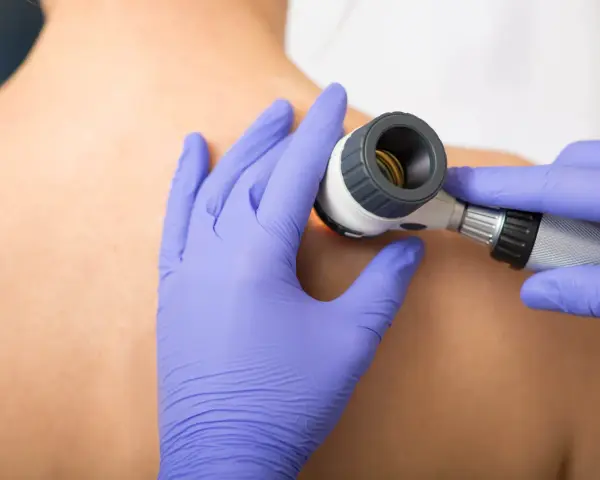 Dermatolog bada dużą ilość pieprzyków na plecach pacjenta za pomocą dermatoskopu.
