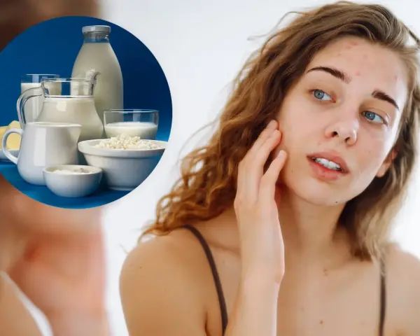Młoda kobieta z trądzikiem dotyka twarzy, obok niej w okręgu produkty mleczne, w tym kefir.
