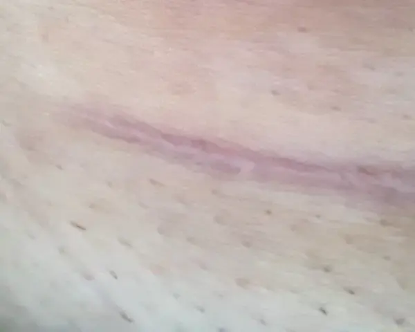 Widoczna blizna na szyi po operacji, lekko różowa, z drobnymi włoskami na skórze.