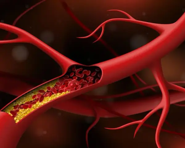 Przekrój naczynia krwionośnego z żółtymi złogami cholesterolu, które powodują, że naczynia krwionośne obkurczają się, utrudniając przepływ krwi.