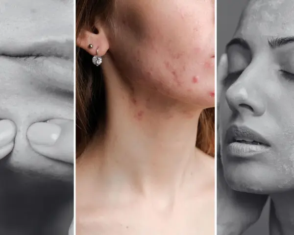 Trzy panele pokazujące problemy skórne: wyciskanie pryszcza, trądzik na twarzy i szyi, oraz pielęgnacja skóry. Dermatologia i wenerologia w praktyce.