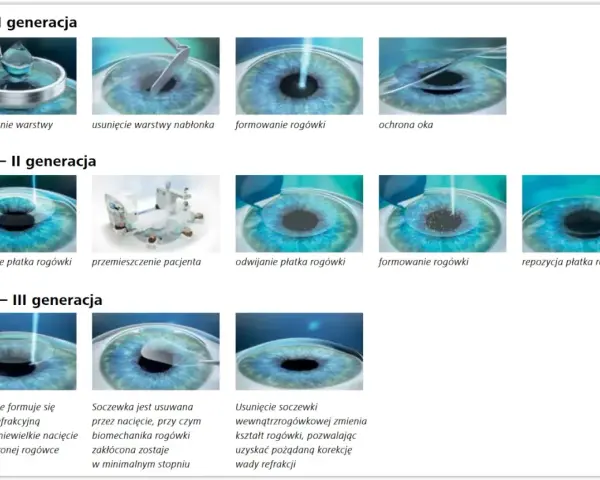 Ilustracje pokazują metody korekcji wzroku laserem: PRK, LASIK, SMILE. Nie ma tu informacji o laserze na kręgosłup lędźwiowy przeciwwskazania.