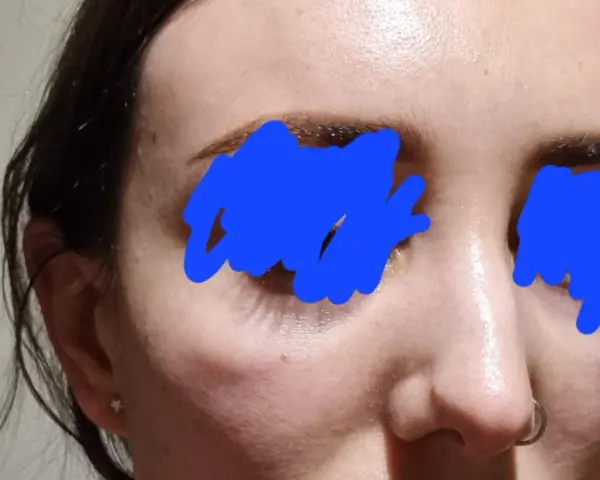 Widoczna opuchlizna po laserze frakcyjnym pod oczami i na policzkach. Skóra jest lekko zaczerwieniona i błyszcząca.