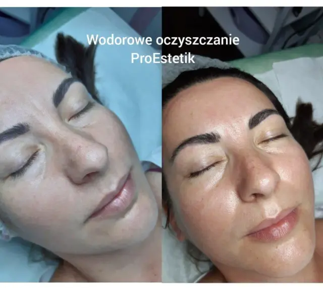Przed i po zabiegu oczyszczania wodorowego. Skóra po zabiegu jest promienna i nawilżona.