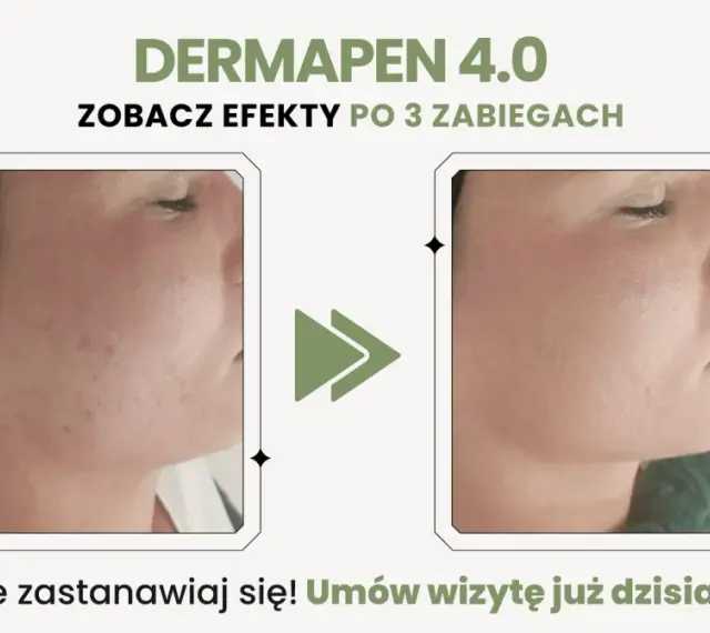 Przed i po zabiegu Dermapen 4.0: skóra z niedoskonałościami staje się gładka. To dowód, co to jest Dermapen.