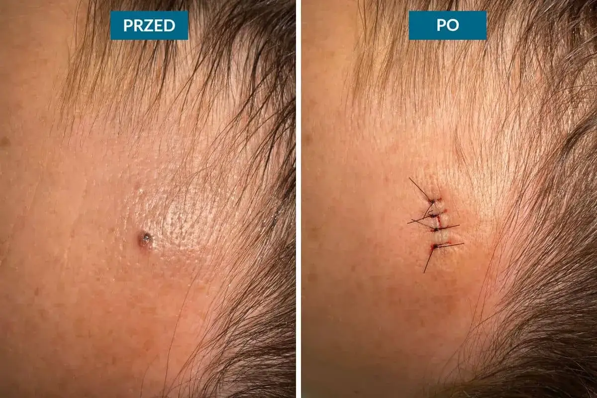 Przed i po usunięciu pieprzyka na twarzy. Widoczne blizny po zabiegu.