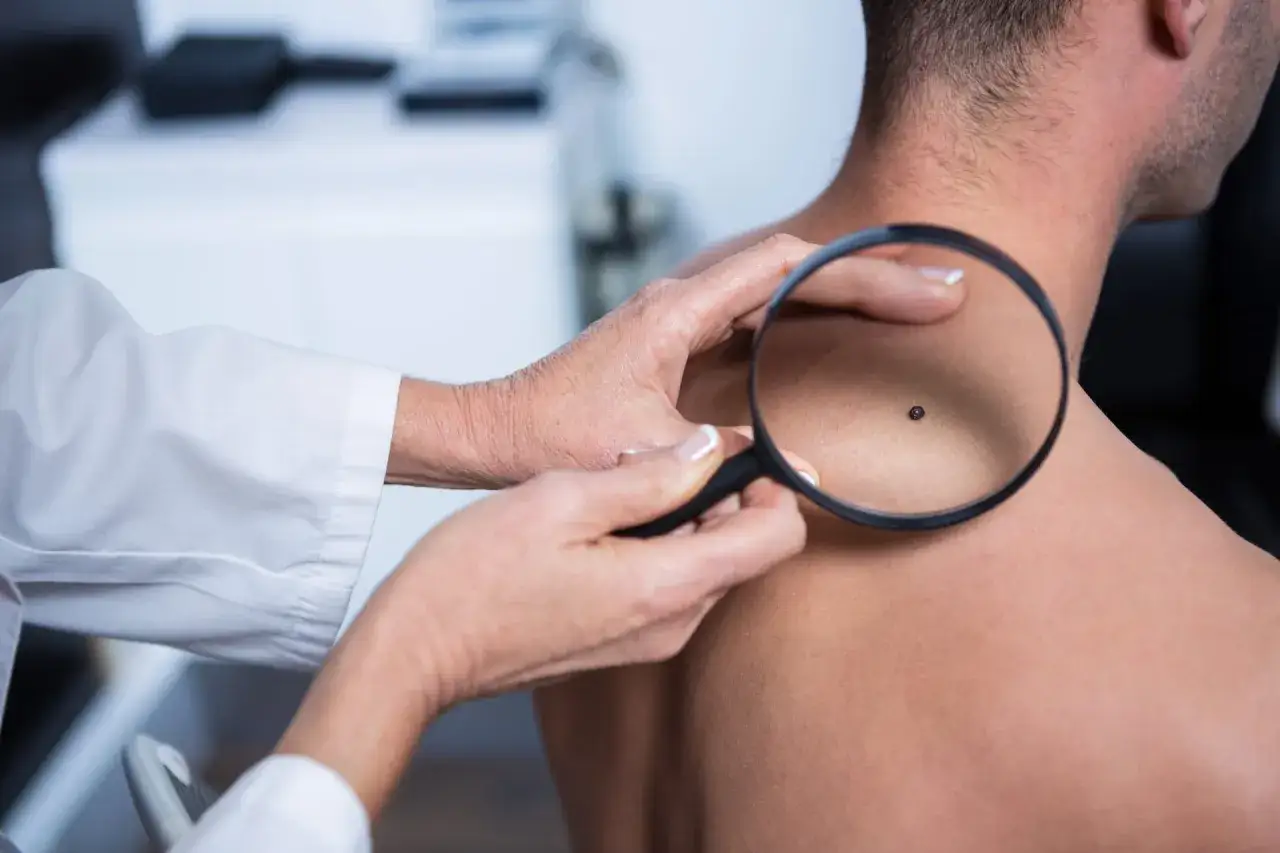 Dermatolog bada zgrubienie na skórze pacjenta przez lupę.