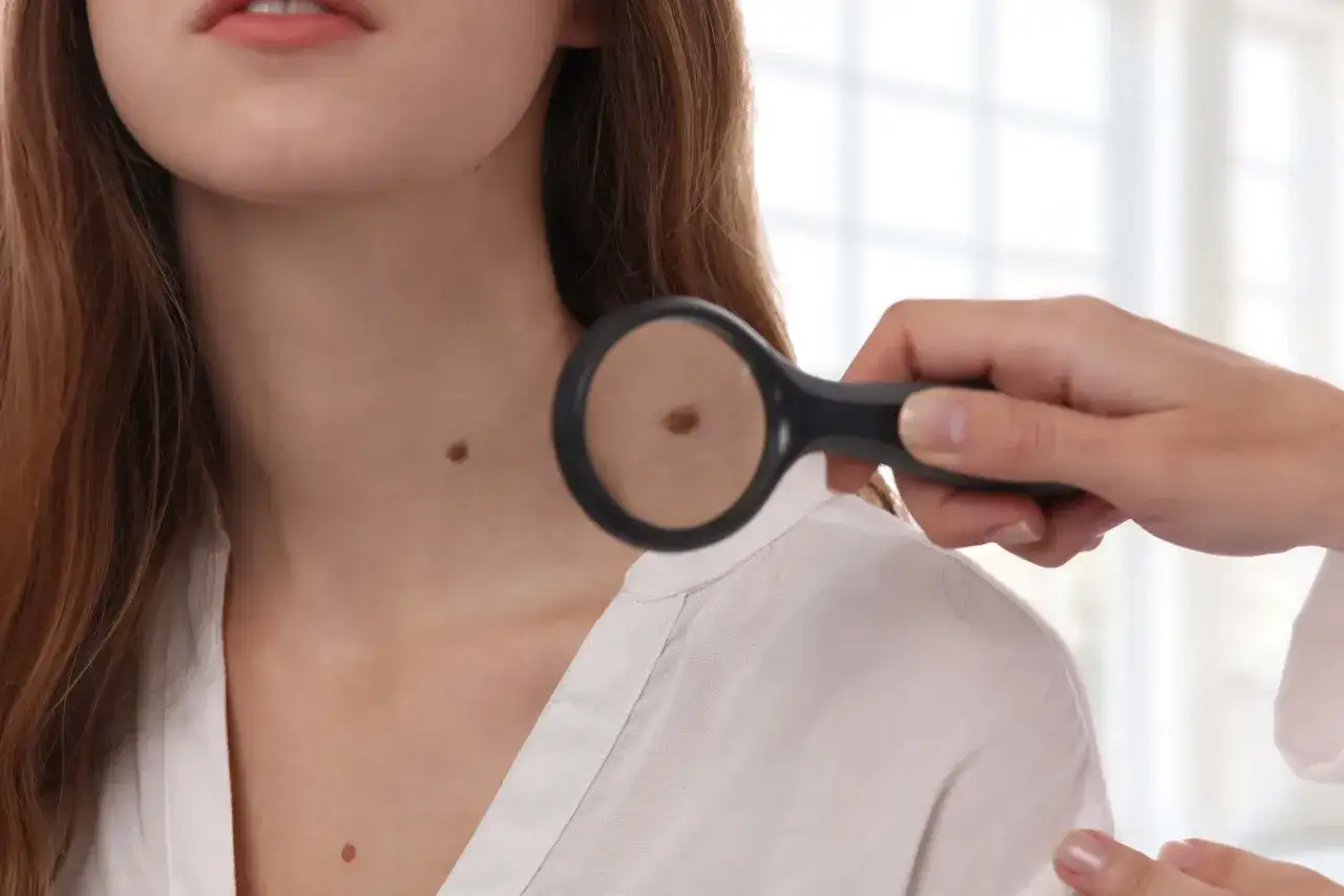 Dermatolog bada pieprzyk na policzku pacjentki za pomocą lupy.