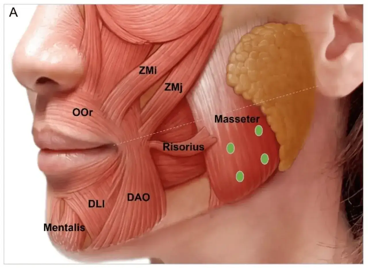 Anatomia mięśni żwacza z zaznaczonymi punktami iniekcji botoksu.