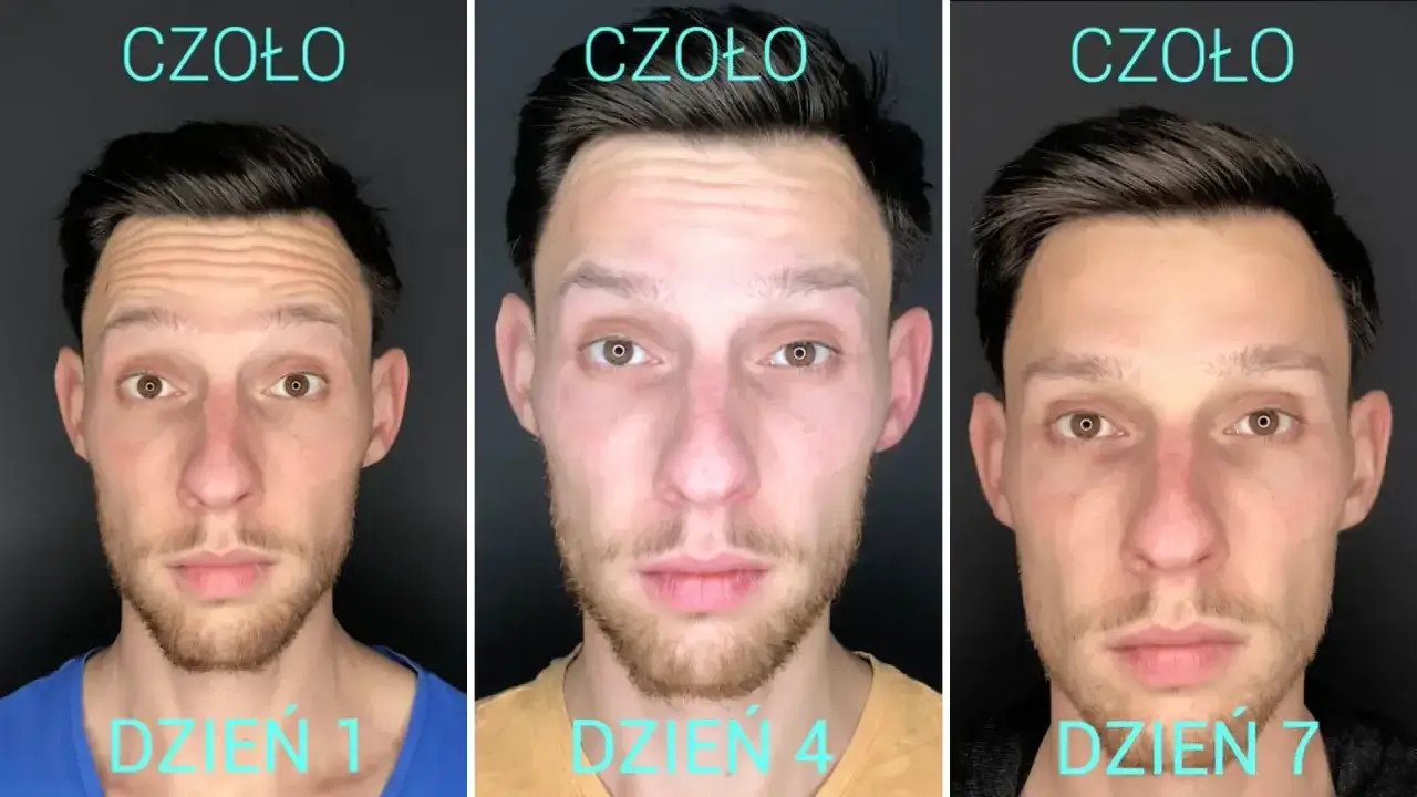 Efekt botoks czoło przed i po: dzień 1 - widoczne zmarszczki, dzień 4 i 7 - wygładzone czoło.