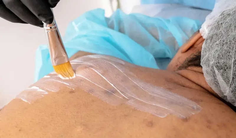 Profesjonalna mezoterapia na trądzik. Kosmetolog nakłada białą maskę na skórę pacjenta pędzlem.