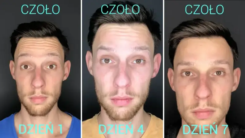 Przed i po baby botox na czole. Widoczne wygładzenie zmarszczek w ciągu 7 dni.